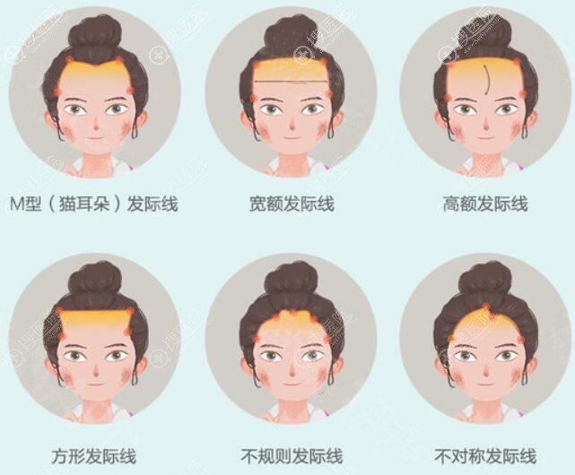 不规则发际线类型 不规则发际线类型