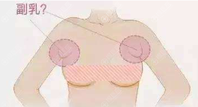 去除双侧副乳手术一般多少钱?副乳切除是微创好还是开刀好