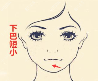 自体脂肪填充下巴多少钱? 自体脂肪填充下巴多少钱?