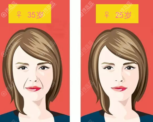 全脸埋线提升用美国强生鱼骨线好还是压印线好?两者区别是什么