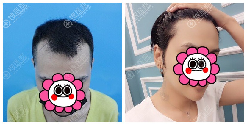 广州倍生M型发际线植发案例 广州倍生M型发际线植发案例