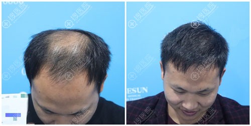 广州倍生头顶加密植发案例 广州倍生头顶加密植发案例