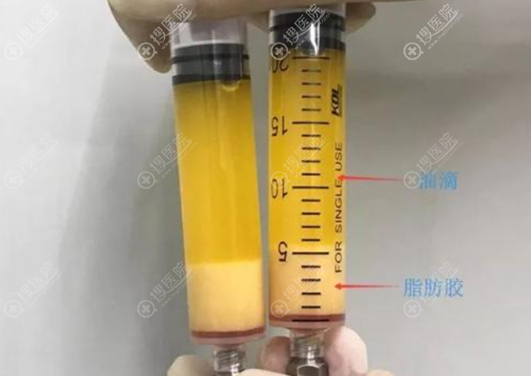 SVF脂肪胶全脸填充存活率高是不是坑,真不需要二次填充了吗?