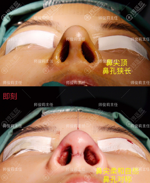 师俊莉鼻子修复做的怎么样 师俊莉鼻子修复做的怎么样