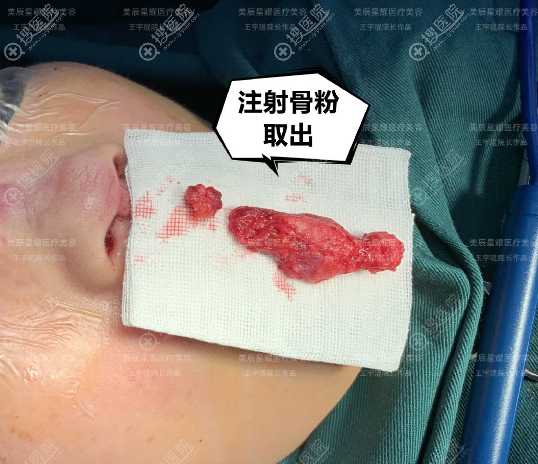 王宇琨院长做的鼻子修复效果图 王宇琨院长做的鼻子修复效果图