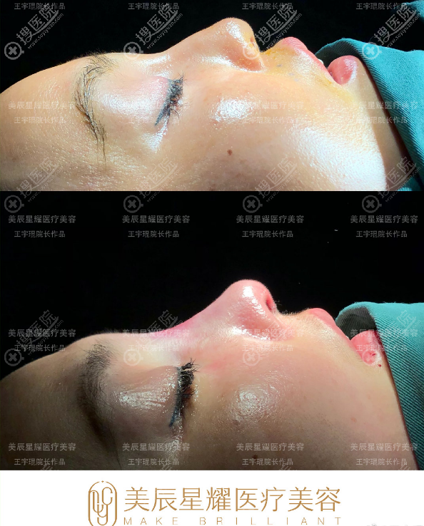 王宇琨做的鼻修复效果好看又自然 王宇琨做的鼻修复效果好看又自然