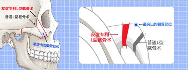 一、韓國合意顏得整形外科怎麼樣?先看這張關鍵資訊懶人包