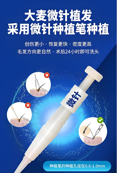 成都大麦微针植发技术怎么样