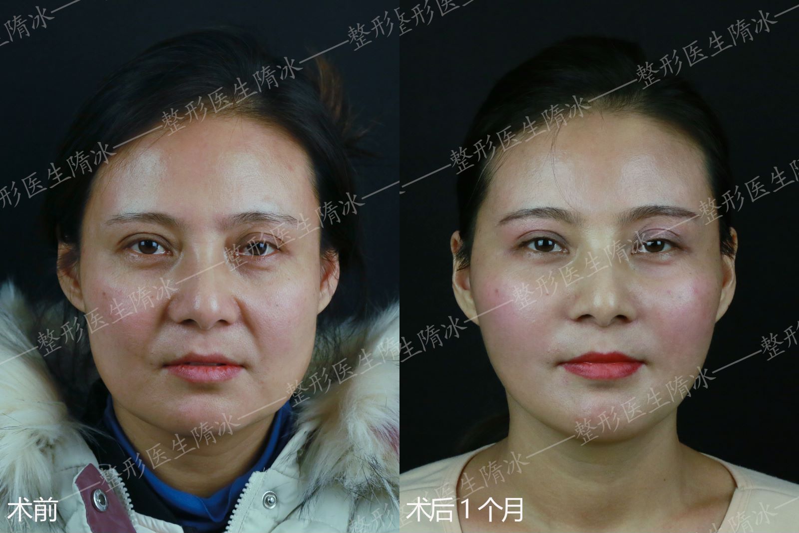 一、 北京子彦丽格医疗美容诊所主推项目与价格:的眼周年轻化方案