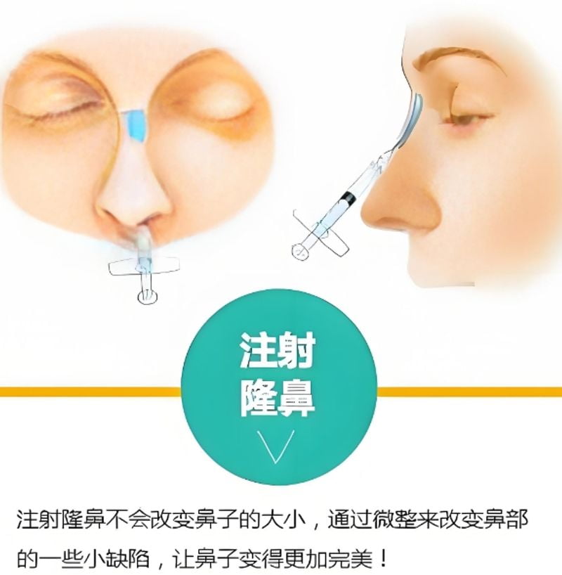 三、刘彦军鼻综合/鼻修复收费价格:为什么有人说6万有人说15万?