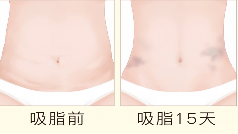 北京纯脂冯斌吸脂自体脂肪隆胸