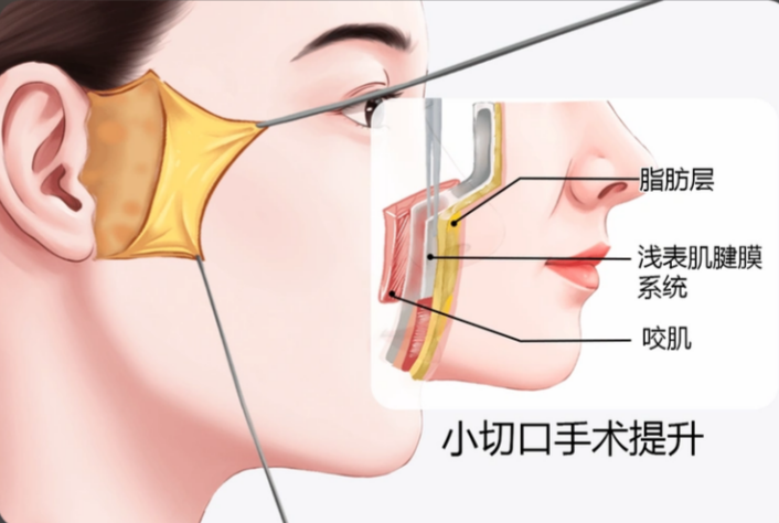 北京黄寺杜太超小切口拉皮手术
