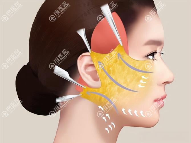 杜太超医生拉皮手术价格表 杜太超医生拉皮手术价格表