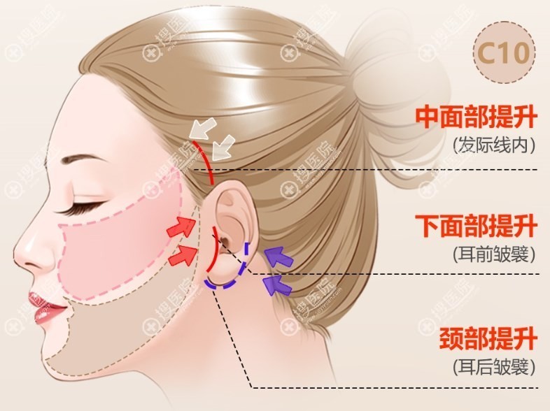 袁强拉皮手术价格表 袁强拉皮手术价格表