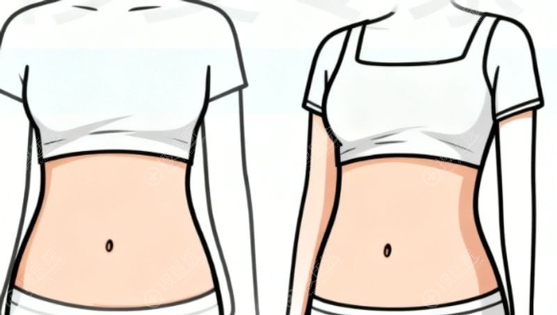 1. 钝性逐层扫描,轻损伤取脂