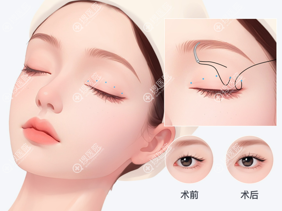 北京丰联丽格师丽丽眼修复价格表 北京丰联丽格师丽丽眼修复价格表