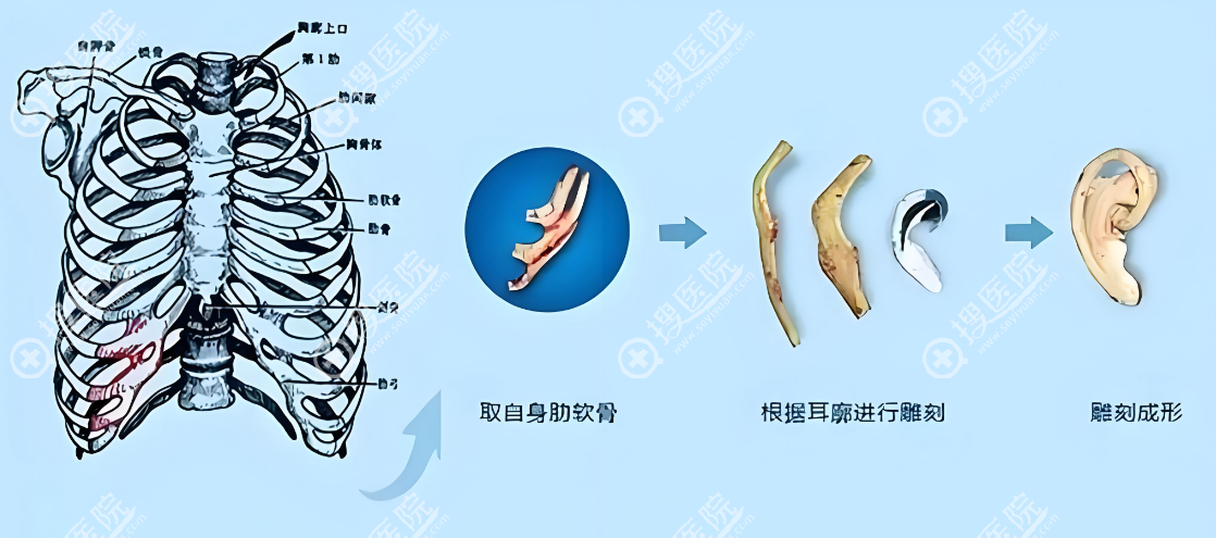 河南整形美容医院张正文耳再造价格表 河南整形美容医院张正文耳再造价格表
