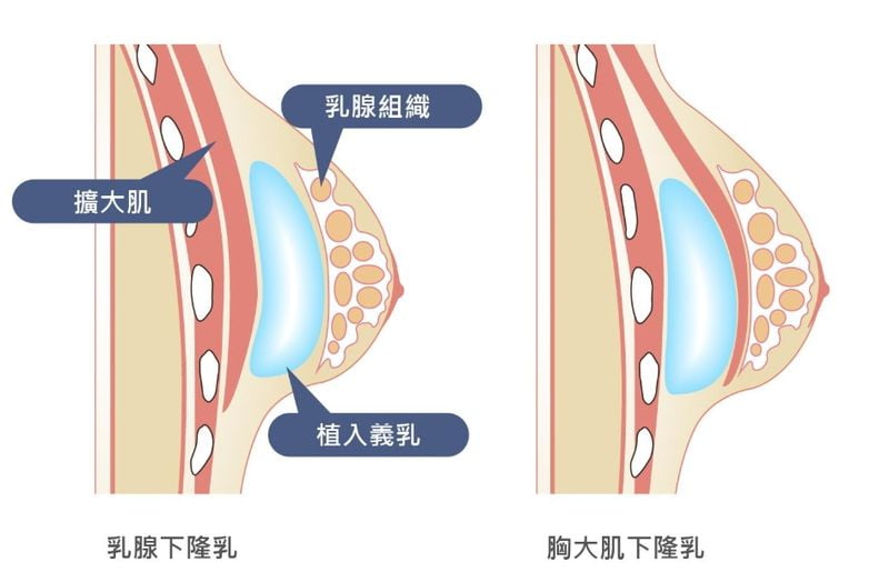 一、裴旭芳隆胸怎么样