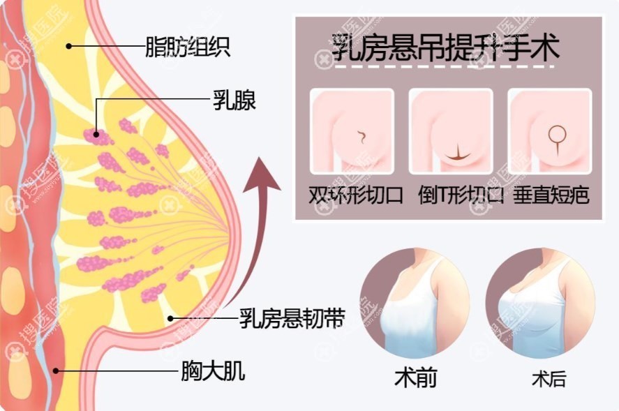 唐新辉隆胸手术价格表 唐新辉隆胸手术价格表