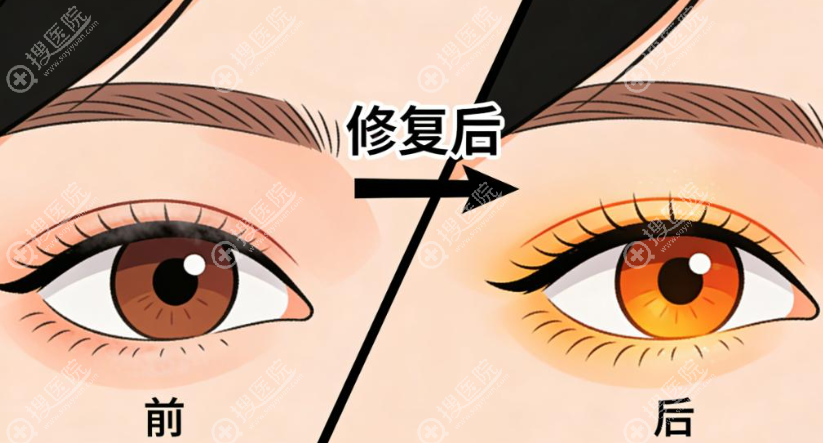 沈阳杏林房红超医生做双眼皮怎么样 沈阳杏林房红超医生做双眼皮怎么样
