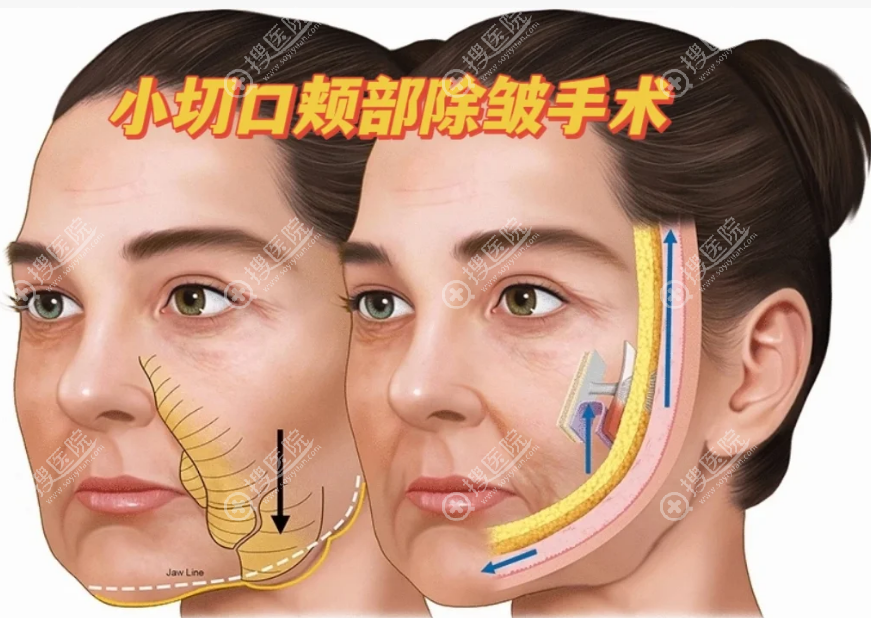朱立德小拉皮手术怎么样 朱立德小拉皮手术怎么样