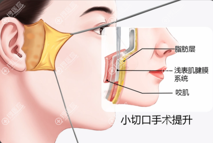 北京三医中西医结合医院刘文阁拉皮手术价格表 北京三医中西医结合医院刘文阁拉皮手术价格表