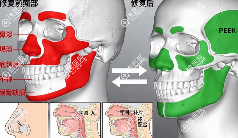 成都刘黎明医生做peek下巴怎么样 成都刘黎明医生做peek下巴怎么样