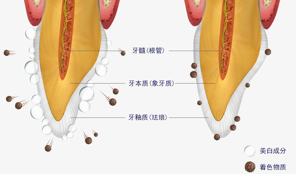 韓國 Minish 牙齒貼面