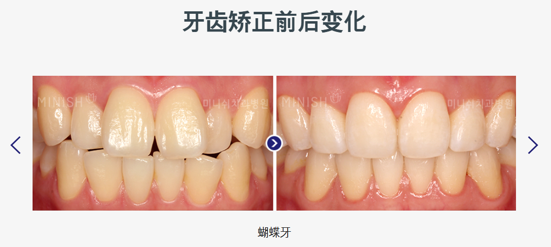 韓國 Minish 牙齒矯正|隱適美隱形矯正 500 萬韓元起,異地複診安排完整整理