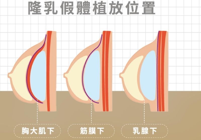 四、张建英隆胸口碑评价——把网上声音分成