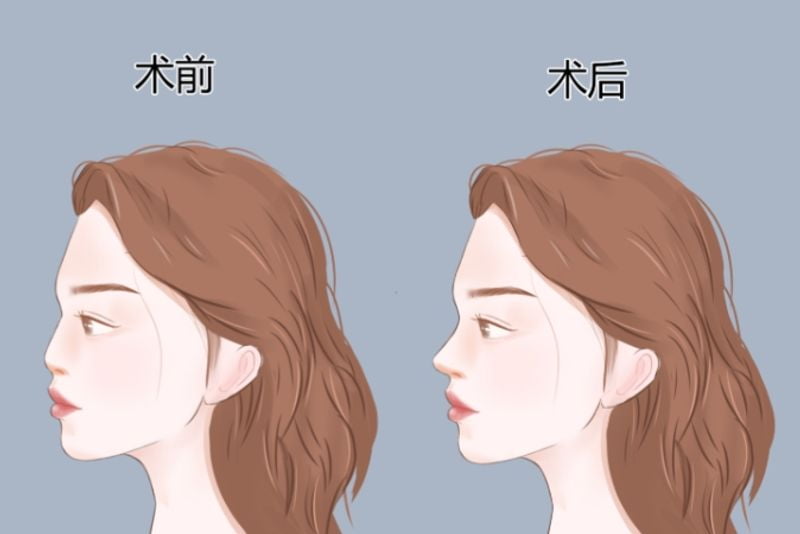 三、上海联合丽格刘一东做鼻子的收费标准与价格构成