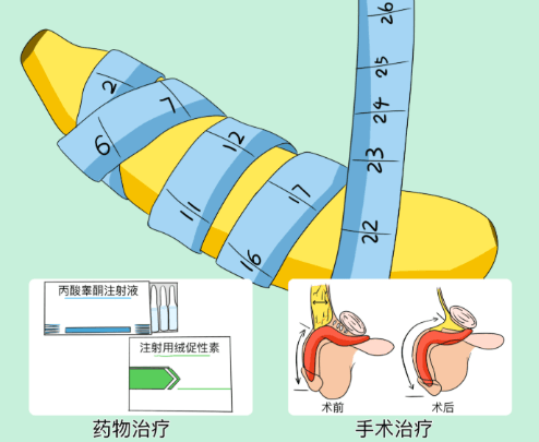 四、关于在广州建国医院做增粗延长的常见问题