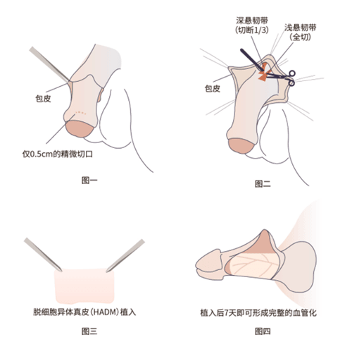 一、广州建国医院王文卫增粗延长怎么样