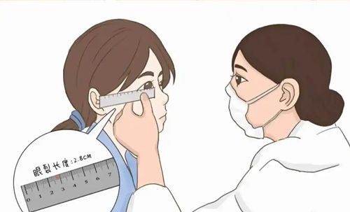 滕双艳双眼皮修复