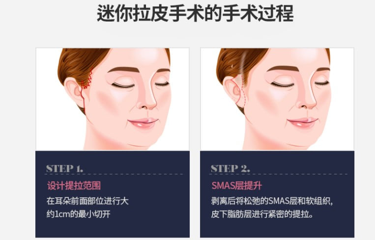 六、Q&A:关于蒲兴旺和拉皮手术的常见问题