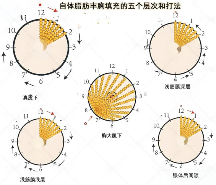 一、深圳阳光整形罗志敏隆胸怎么样