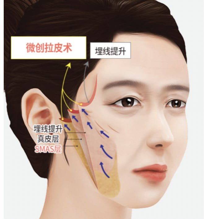 3. 一个关键细节:不伤神经