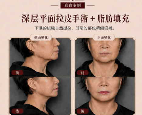 韓國The Plan整形外科醫院拉皮案例
