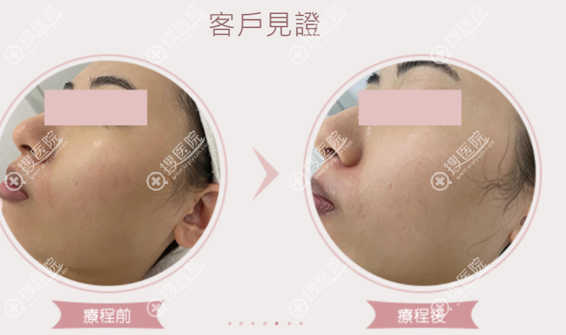 香港GENIC SKIN醫美有哪些祛斑療程 香港GENIC SKIN醫美有哪些祛斑療程