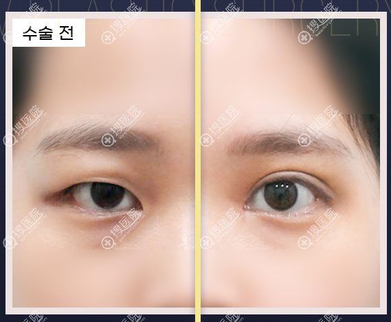 韓國艷羅爾整形外科的眼整形值得重點了解嗎 韓國艷羅爾整形外科的眼整形值得重點了解嗎