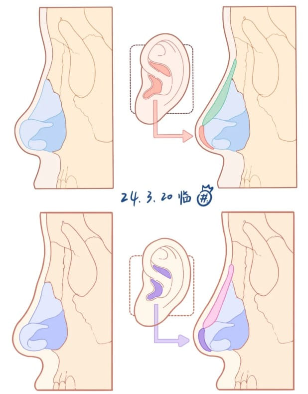 愿妃整形外科医院隆鼻贵不贵?自然小翘鼻反馈多,价格先上BeautsGO查