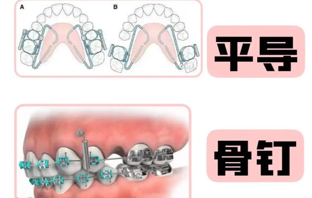 牙齿矫正 牙齿矫正